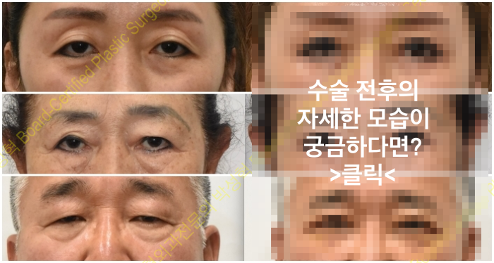 안검하수-교정