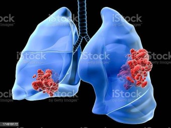 폐암 초기증상