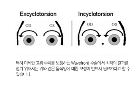 난시 교정수술 비용 치료법