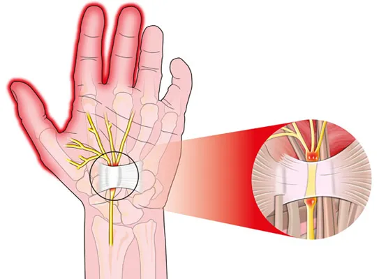 손목터널증후군 증상
