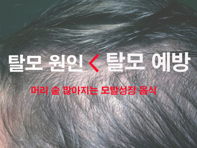 탈모 원인 예방법과 머리 숱 많아지는 모발성장 음식