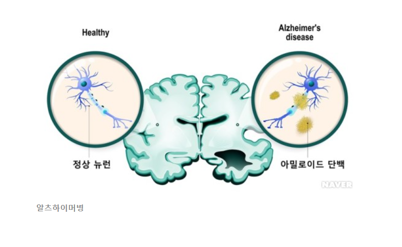 알츠하이머 초기증상 4가지와 대처방법 알아보기