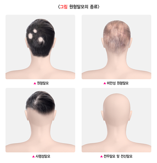  원형탈모
