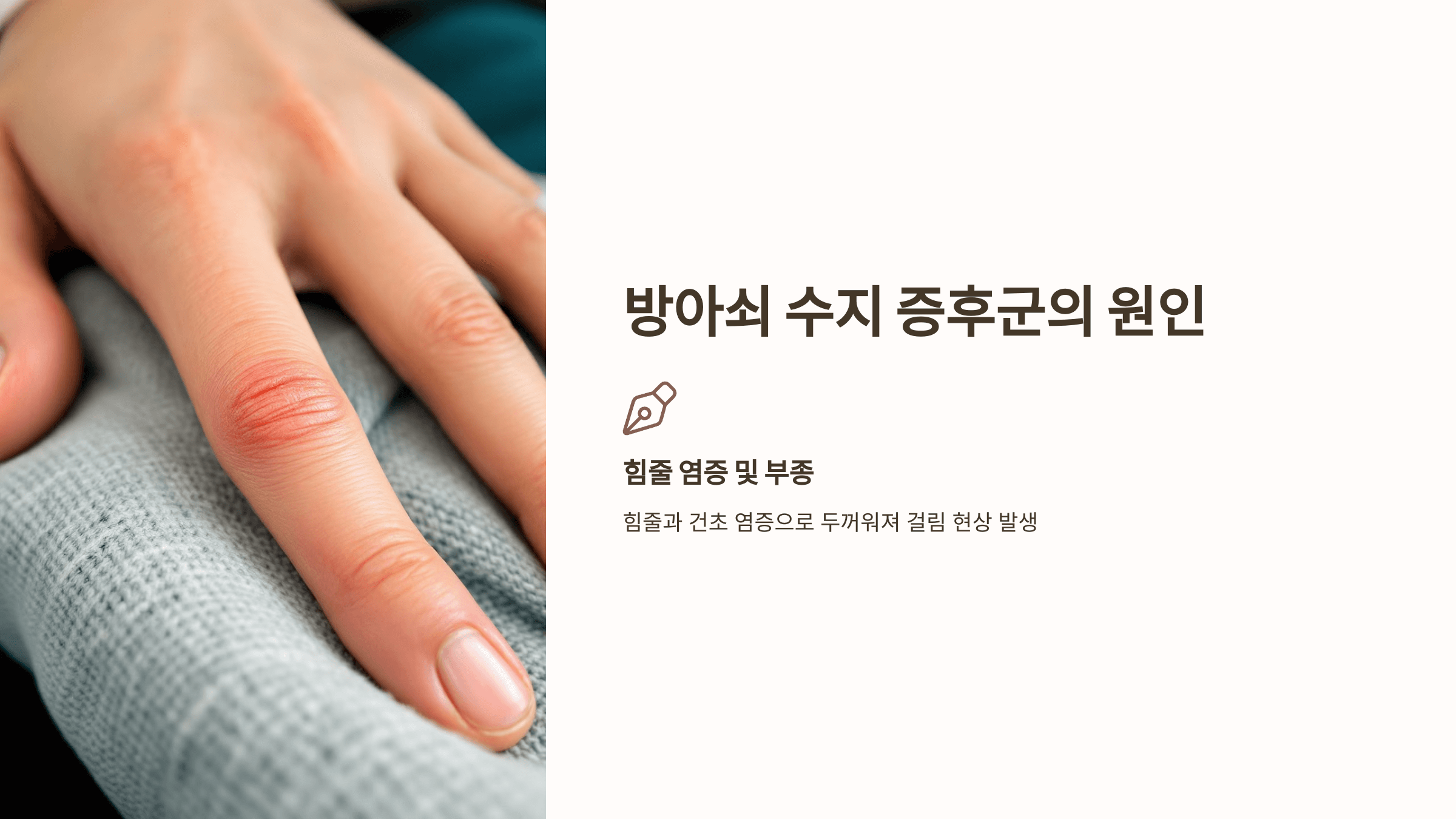 방아쇠 수지 증후군 관련된 사진입니다.