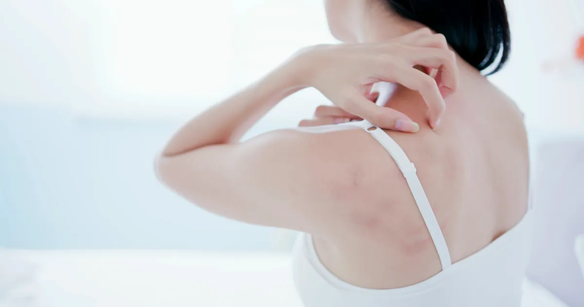 겨울철-피부-건조증-호호바오일-효능