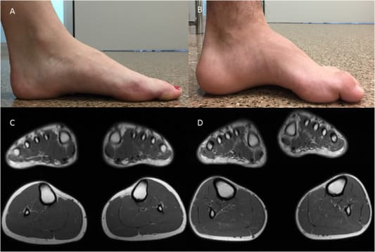 대구경북과학기술원&#44; 세계 최초 샤르코-마리-투스(CMT) 치료법 개발 Scientists develop world&#39;s first Charcot-Marie-Tooth therapy