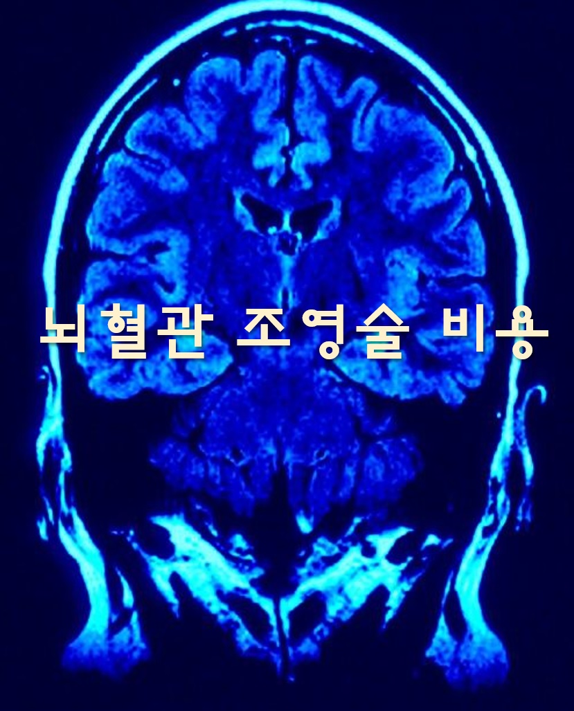  뇌혈관 조영술 비용과 검사 시 촬영 방법