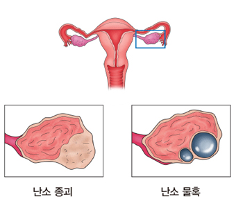 난소낭종