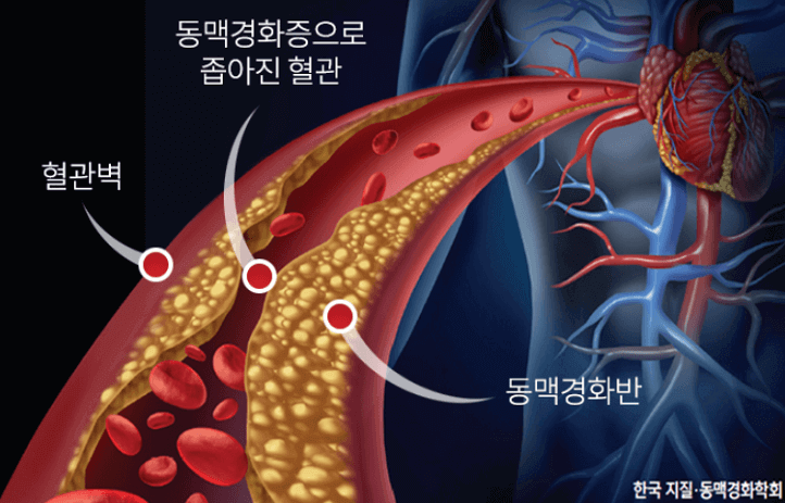 혈관벽