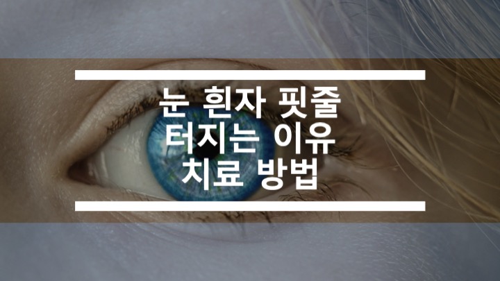  눈 흰자 핏줄 터지는 이유와 치료 방법