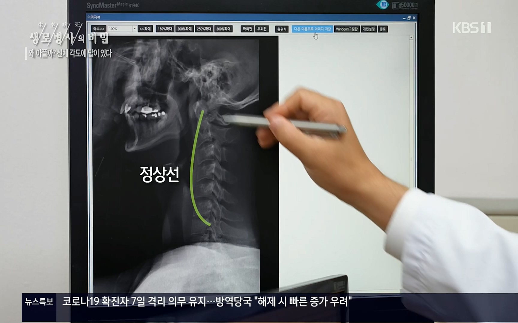 생로병사의 비밀.E825.220706p.H264-F1RST.mp4_20220707_185756.731.jpg