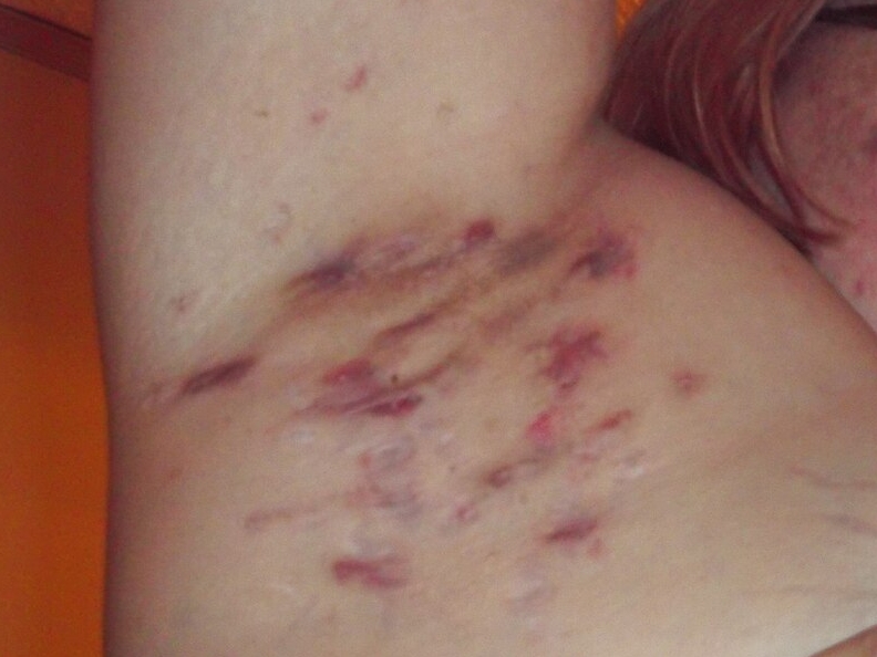 화농성 한선염 원인, 증상, 진단 및 치료 알아두면 좋아요!