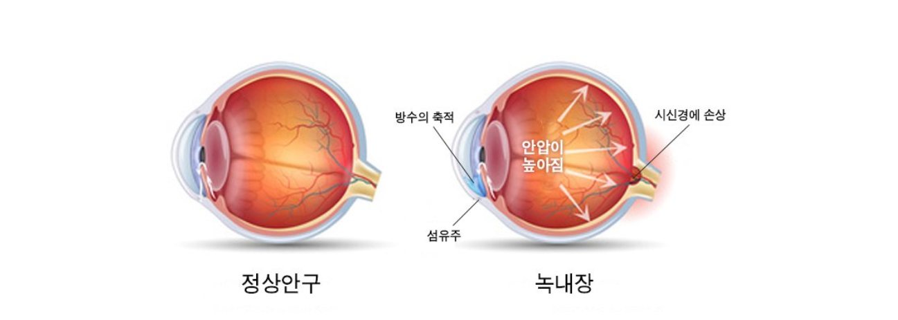  [녹내장 주의] 글씨 크게하고 봐야함. 녹내장 걸림!!!!!!