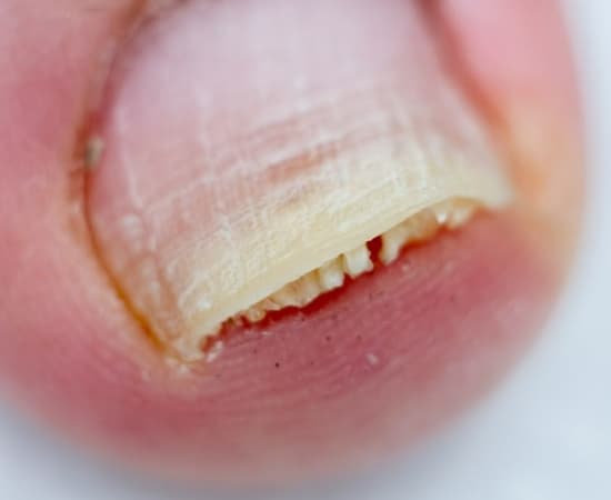 조갑박리증은-손발톱이-피부에서-들뜨는-질환입니다.