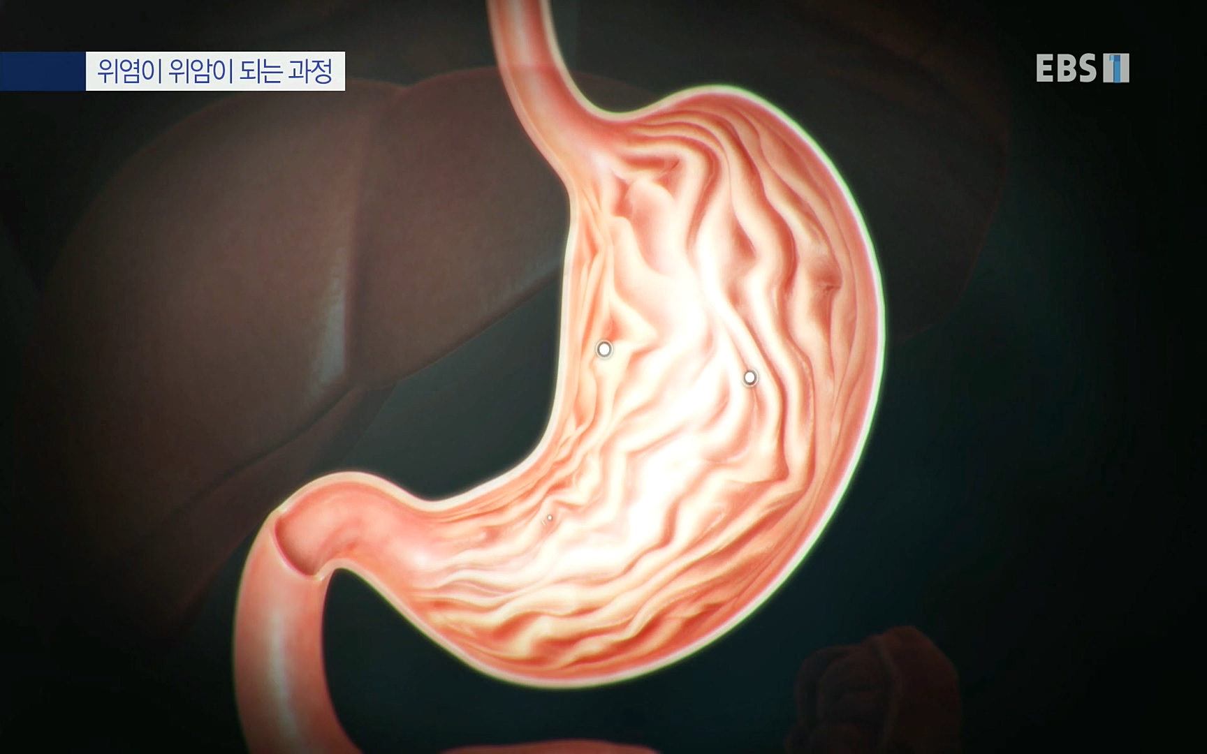EBS 명의 헬스케어 - TV - 교육의 중심 EBS명의 15년, 위암 치료 이렇게 달라졌다!.mp4_20220809_203703.148.jpg