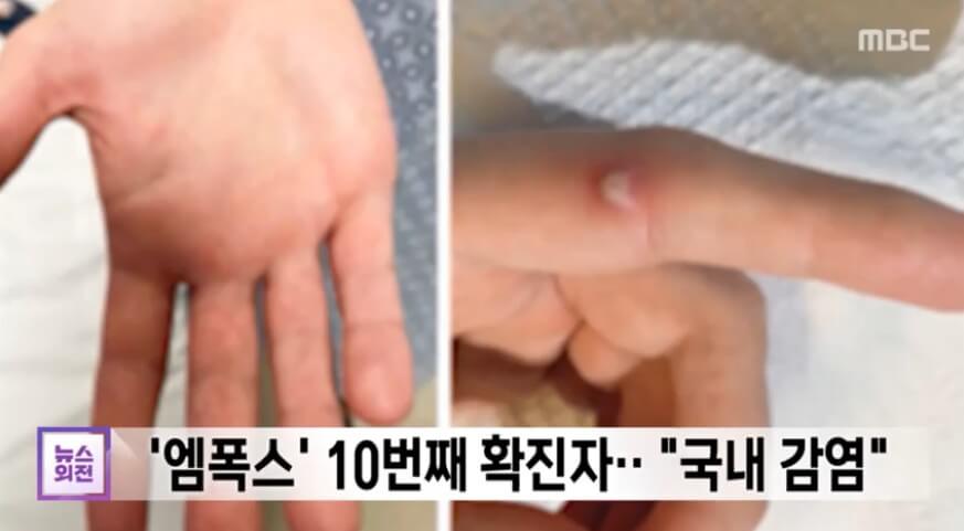 엠폭스-10번째-확진자-국내감염-MBC-뉴스외전-2023.04.14