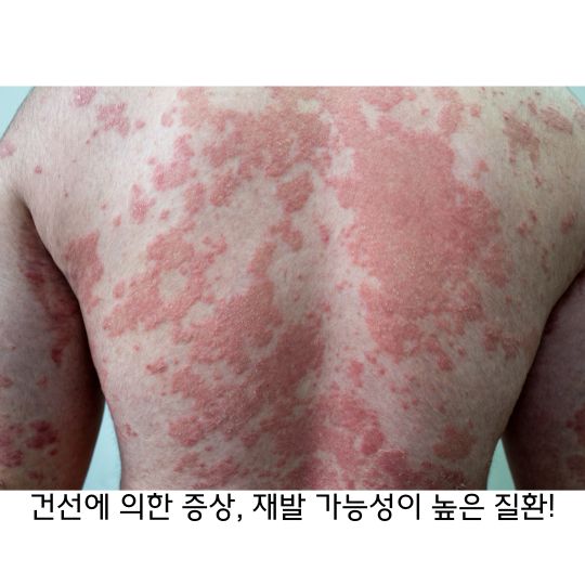  건선 심하면 온몸에 발진이 생기는 질환