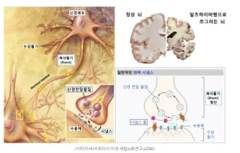 알츠하이머와 치매 차이_8