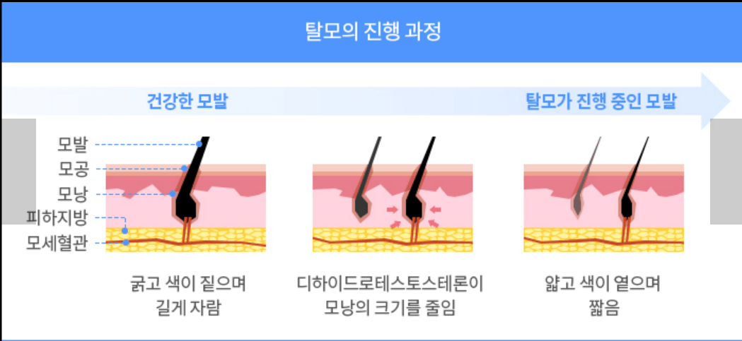 탈모 샴푸&#44; 탈모 치료제&#44; LED 두피케어 상품 추천 후기