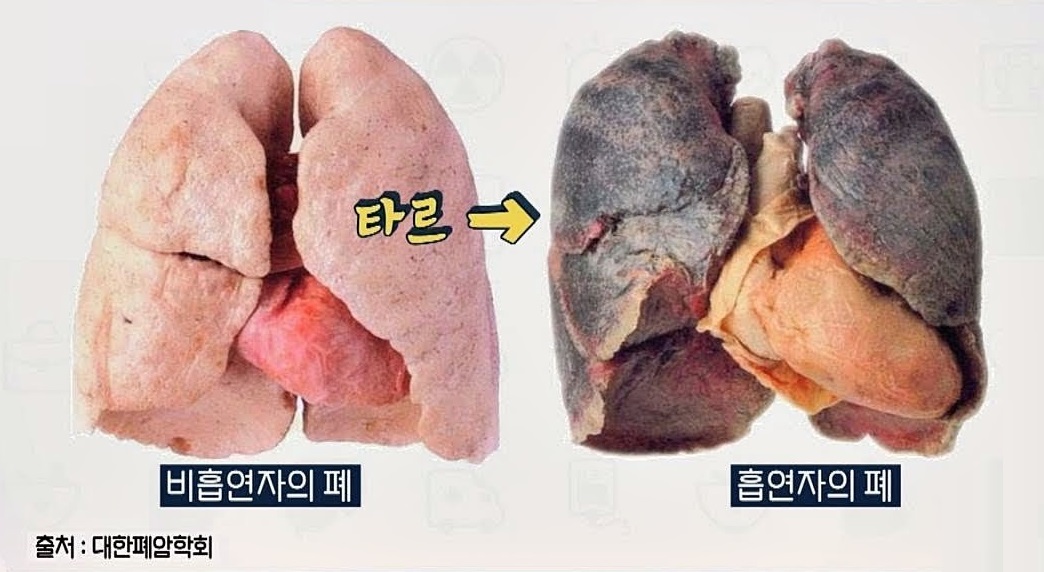  흡연자폐 비흡연자폐