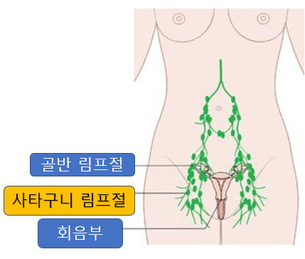 서혜부 림프절