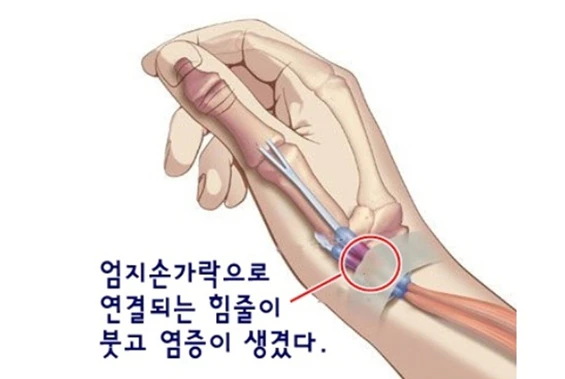 건초염