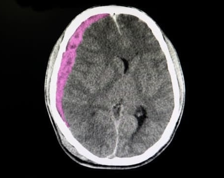 두개골 절개술(Craniotomy): 정의, 과정 및 목적