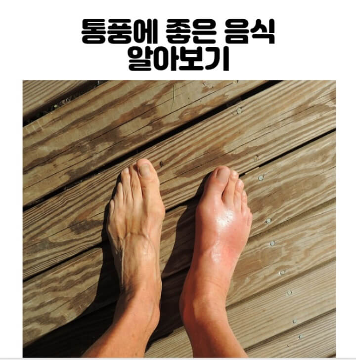 통풍으로-인해-빨갛게-부은-발