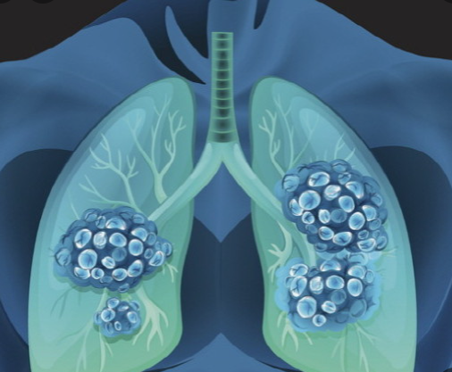 폐암 증상 치료 방법
