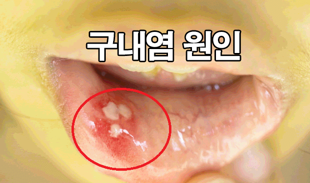  구내염 원인 및 입속 헐었을때 좋은 음식 : 빨리 낫는 법