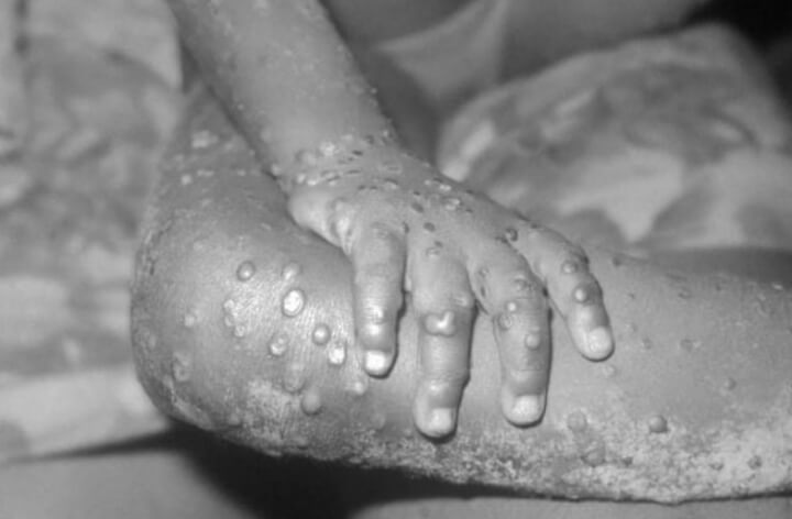  엠폭스 MPOX 원숭이두창 이란
