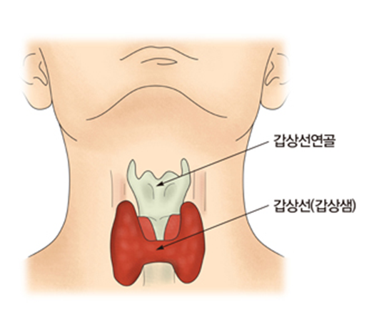 갑상선암(Thyroid cancer) 정의 증상 원인 치료 예방 방법 식사 요법 추천 음식 식단 극복