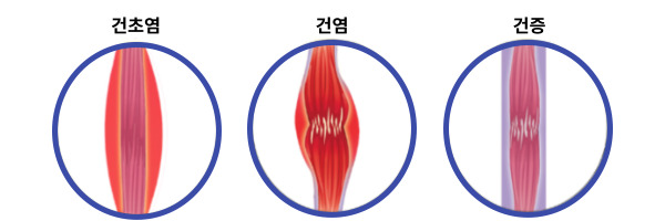 건염과 건증(7)