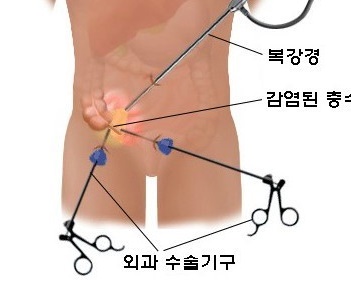  맹장염  초기증상 및 원인 (충수염) 입니다.