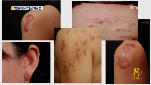  켈로이드성 피부 아무것도 못하나요?