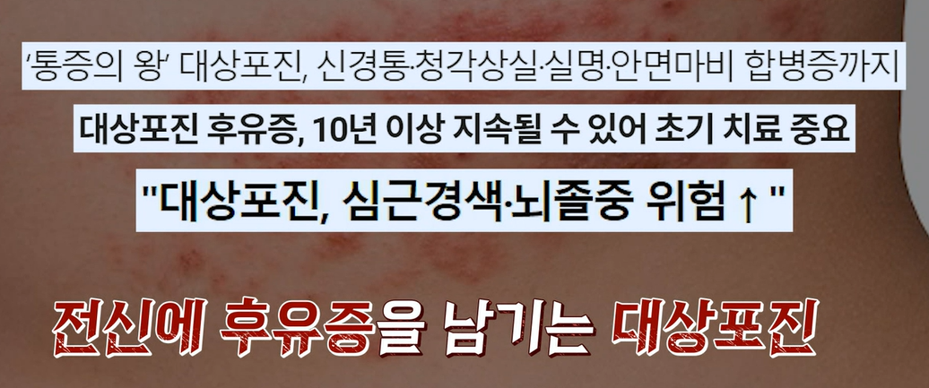 대상포진