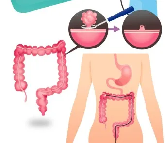 대장내시경 용종제거 후 식사 식단조절_29