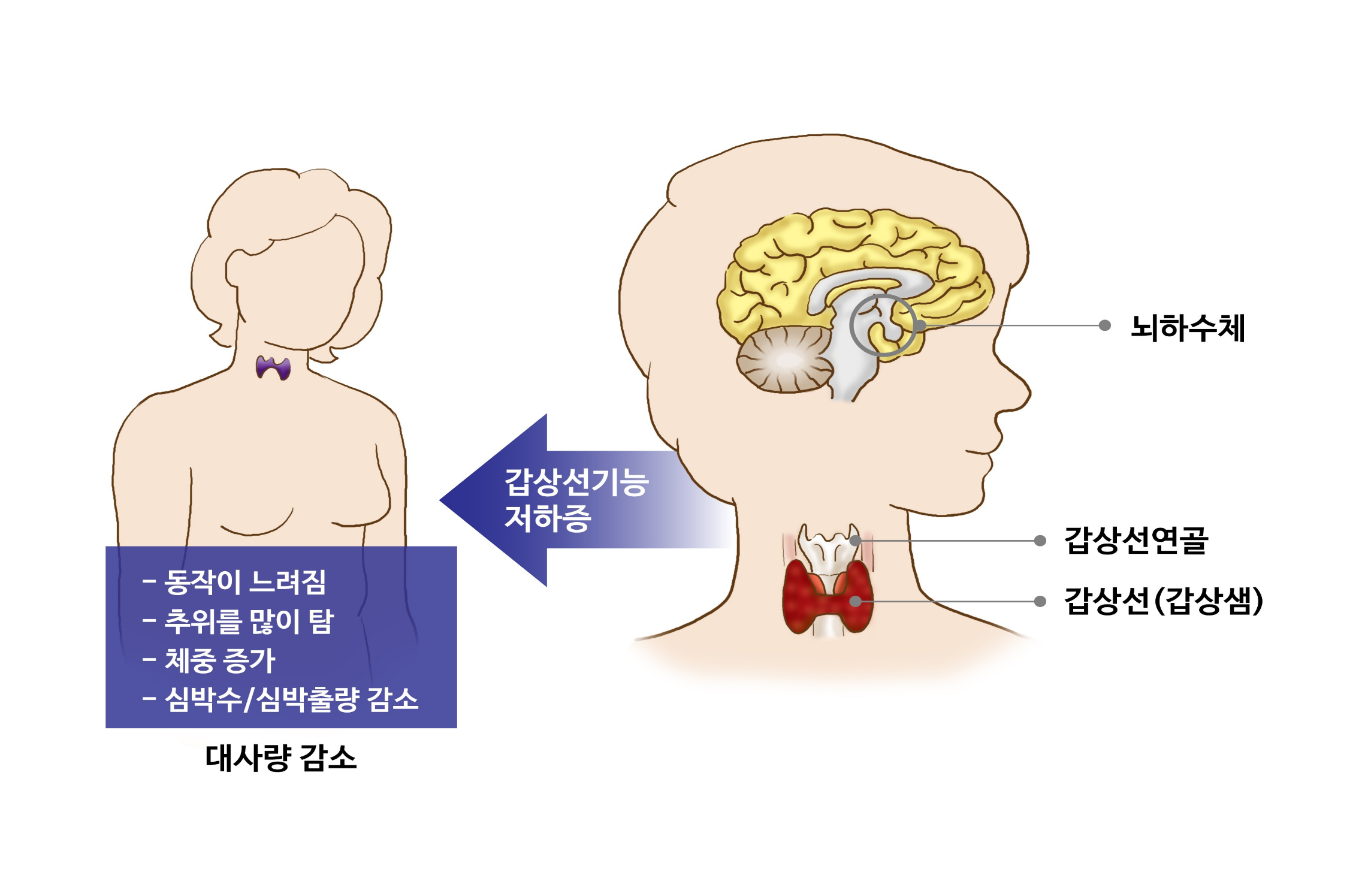 갑상선 기능저하증