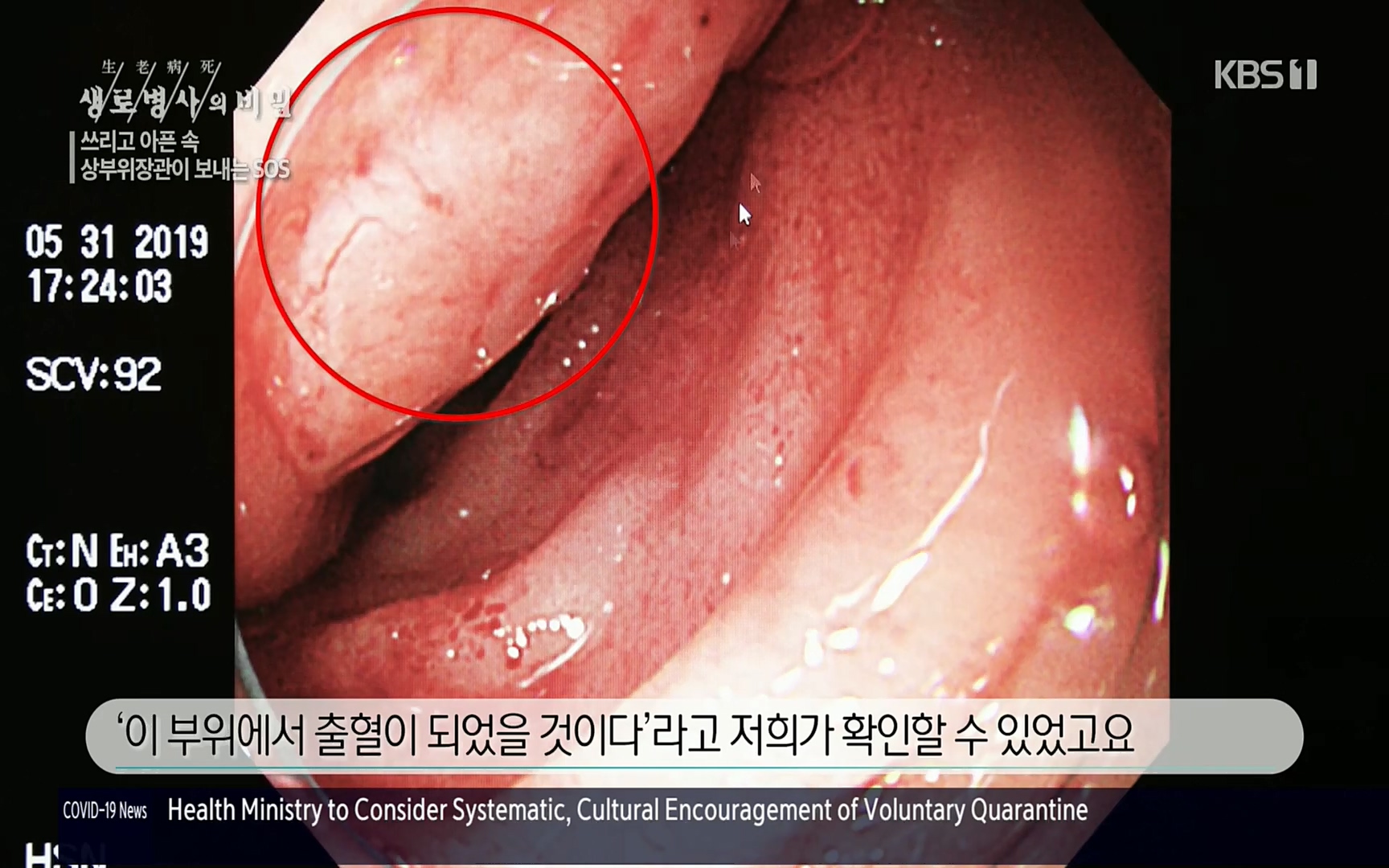 생로병사의 비밀.E822.220615p.H264-F1RST.mp4_20220616_203131.259.jpg