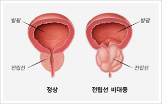 전립선비대증