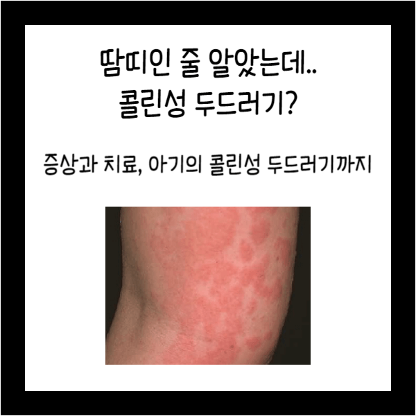  콜린성 두드러기? 증상과 치료방법, 아기 콜린성 두드러기