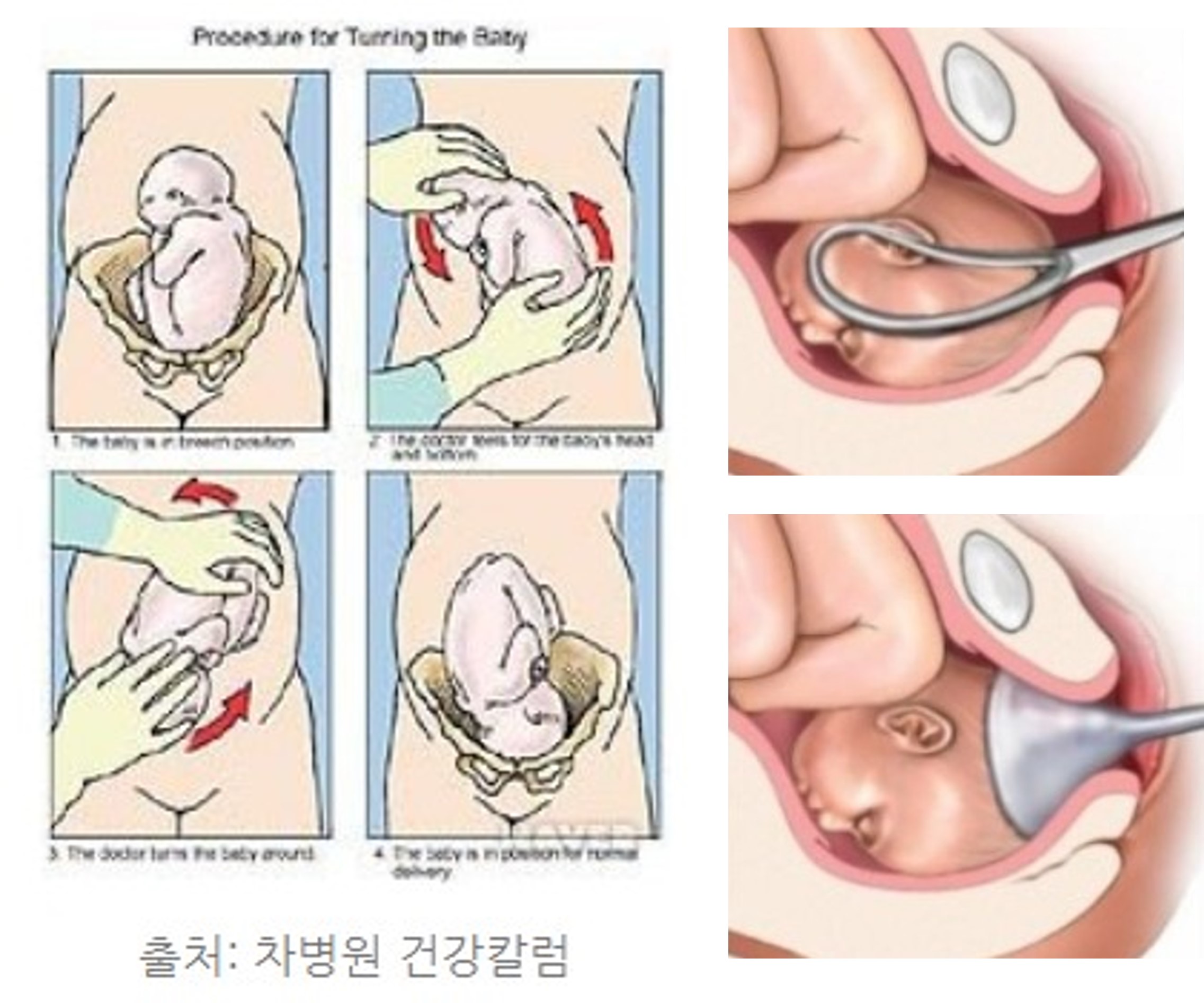 저산소 허혈성 뇌병증 원인 둔위분만&#44; 겸자분만