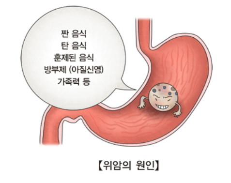 위암원인