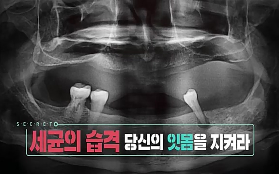 [792회] 생로병사의 비밀 - KBS[세균의 습격, 당신의 잇몸을 지켜라!] 감기보다 병원을 더 자주 찾게 만드는 질병이 있다. 바로 치주질환이다. 2020년 외래 다빈도 질병 1위를 차지한 치은염 및 치주질환 환자는 1,637_20220505_135828.996.jpg