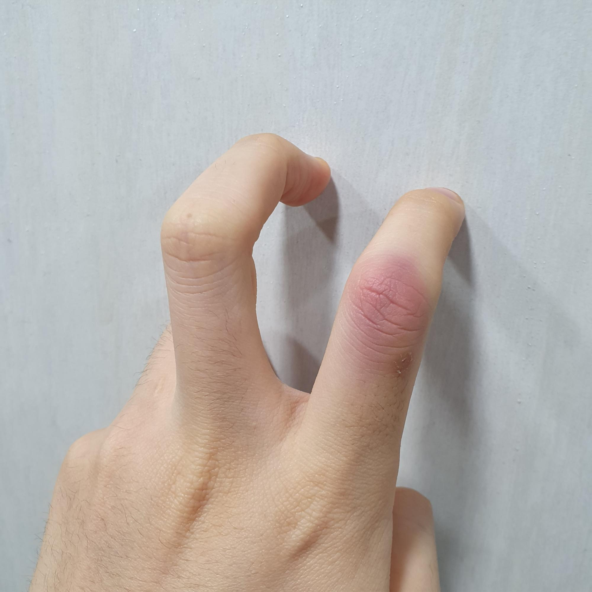 손가락에 결절종이 생긴 후 수술을 해야 하는 이유 6