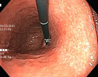 헬리코박터균 제균 치료 치료방법 성공률_5