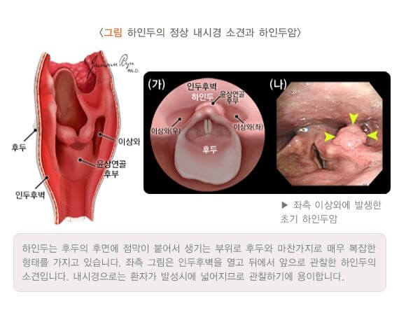 인후염 증상