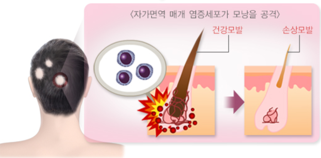 질병관리청 국가건강정보포털(탈모원인 사진)