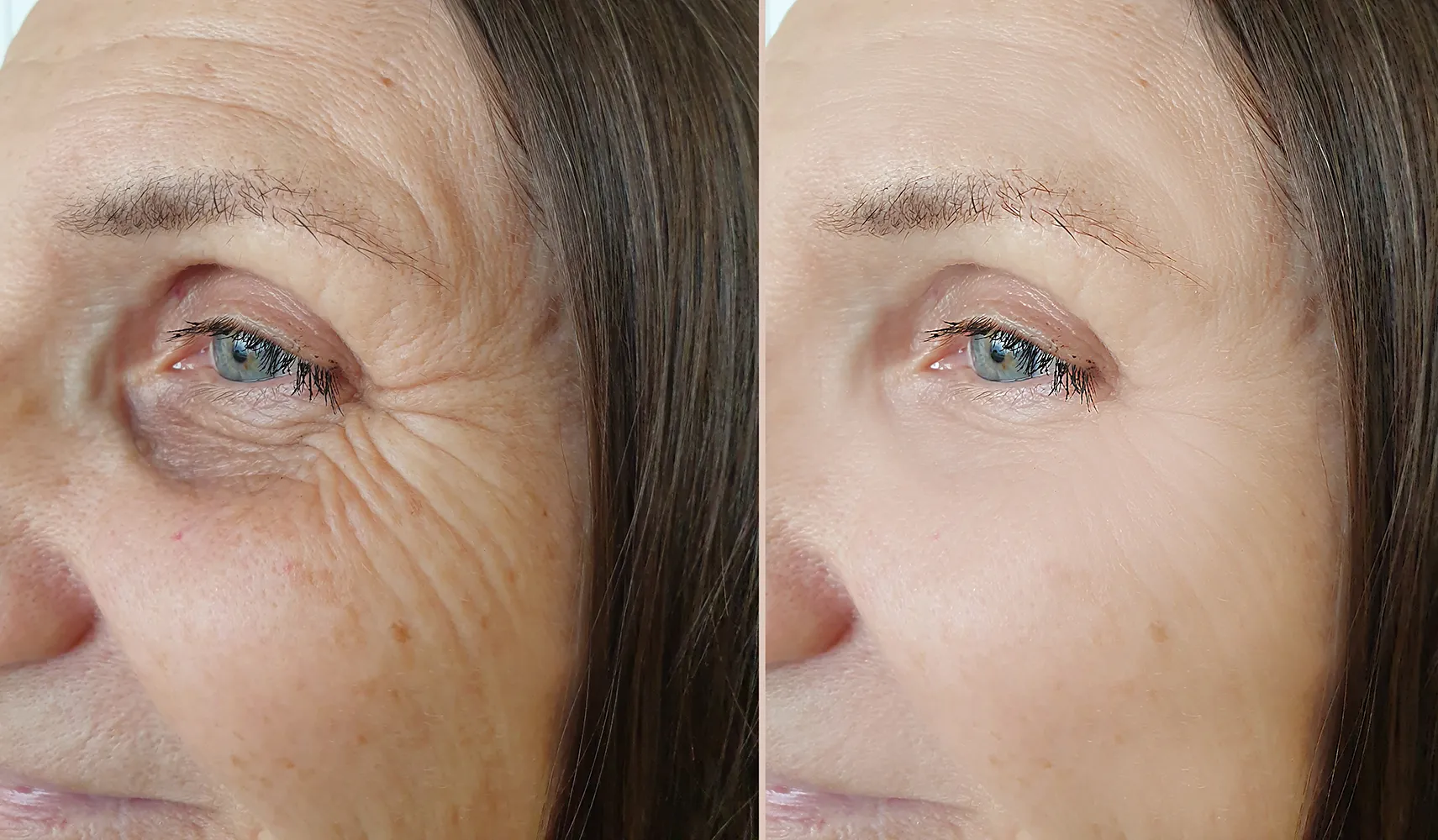 치료 전과 후의 여성 얼굴 주름