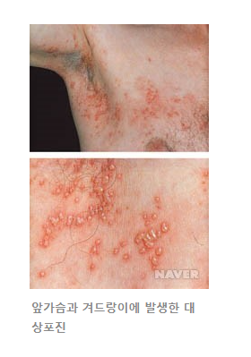 대상포진 초기증상
